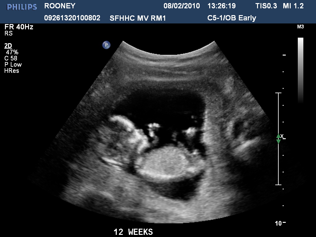 Pregnancy Ultrasound Pictures 12 Weeks